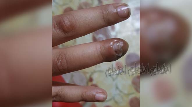إصبع الطفلة سجى بعد العملية وقد بدت بحالة أفضل بعد نمو ظفرها إصبع الطفلة سجى بعد العملية وقد بدت بحالة أفضل بعد نمو ظفرها